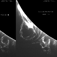 <font class="tempImageTitleThumbText">Erupting Solar Prominence</font><br>Richard Fleet<br>Nov 9 9:28pm<br>Pewsey Vale, Wiltshire, England